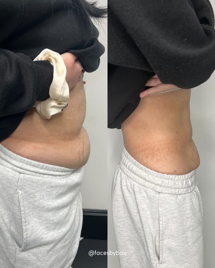 80K Cavitation — Fat Reduction — before and after result