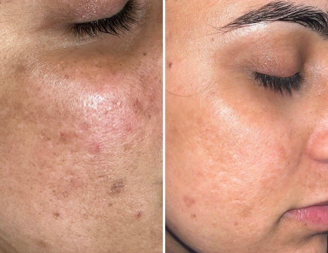 Carbon Facial — before and after result