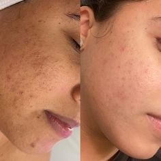 Chemical Peeling — before and after result