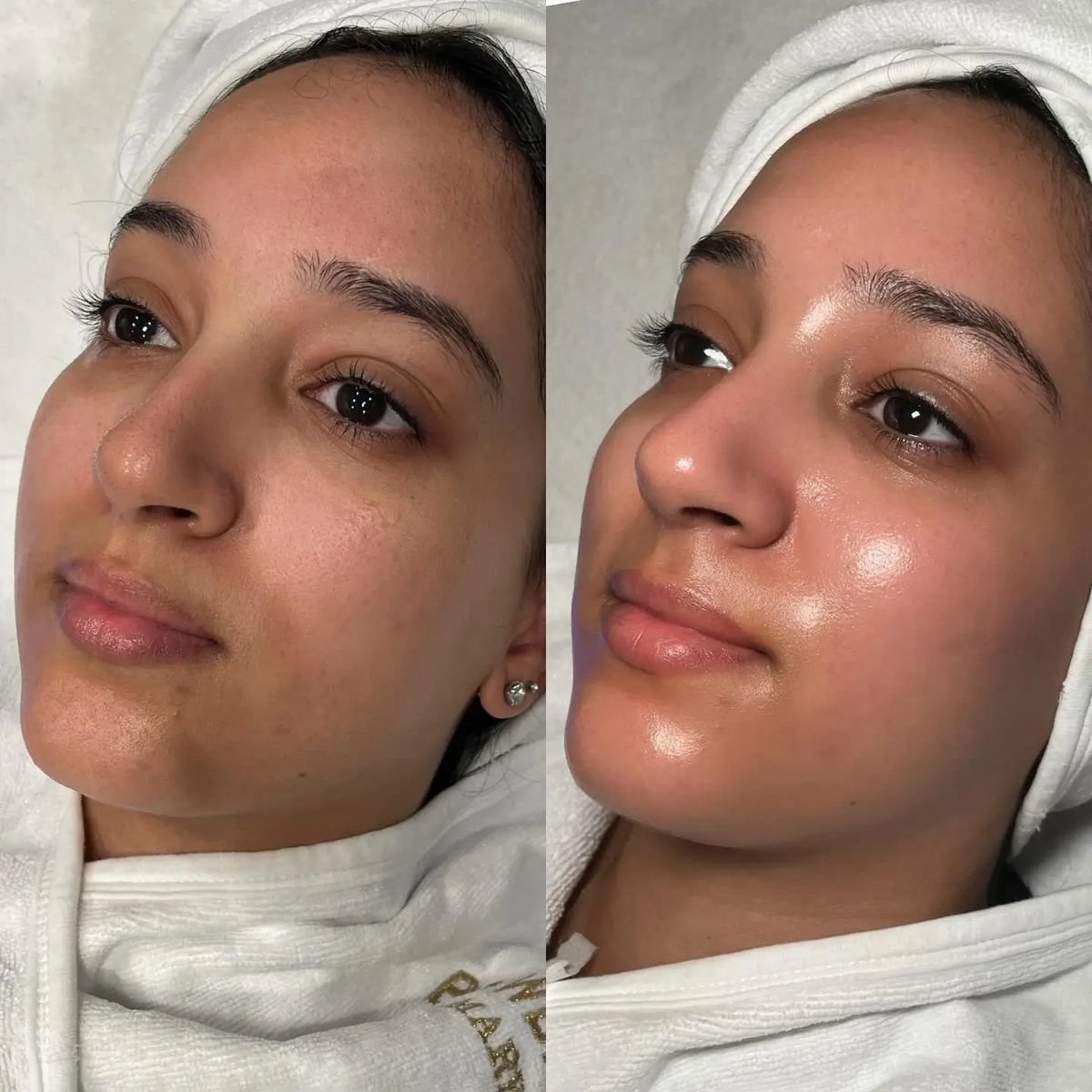 Hydrafacial — before and after result