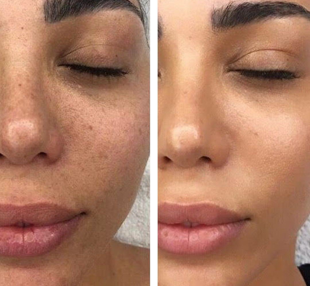 IPL Photofacial — before and after result