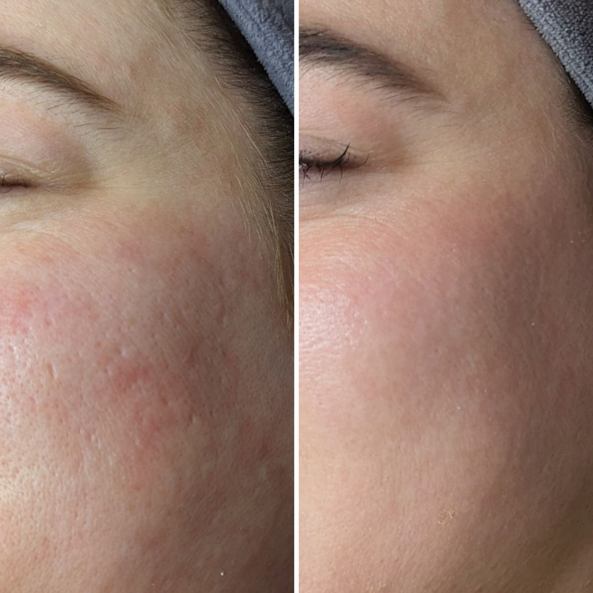 Microneedling — before and after result