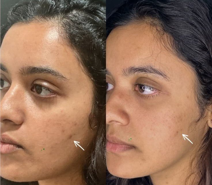 Pico Laser — before and after result