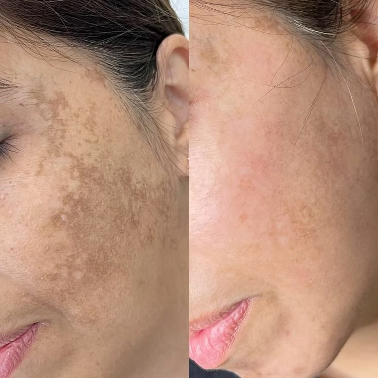 Pigmentation Treatment — before and after result