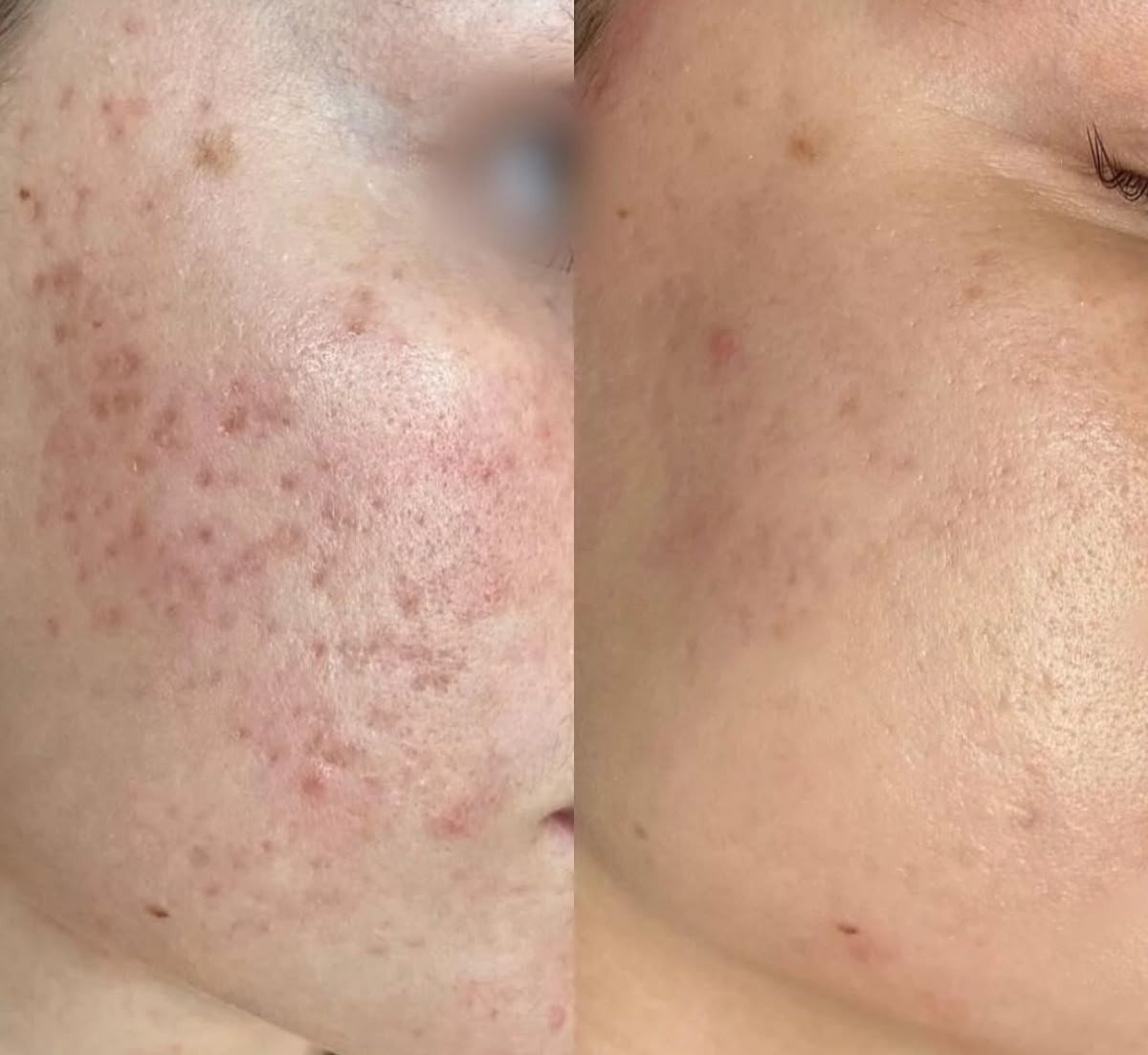 PRP / PRF Treatment — before and after result