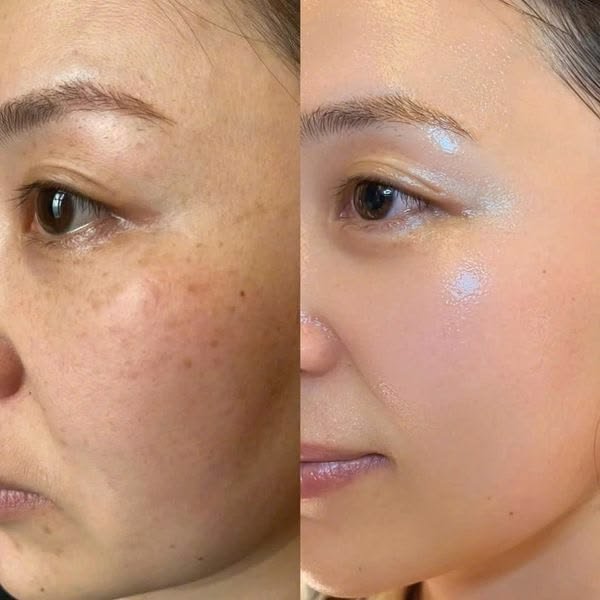 Skin Whitening & Rejuvenation — before and after result
