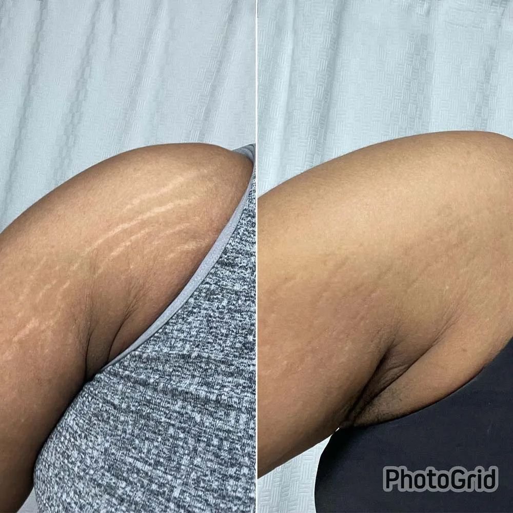Stretch Marks & Old Scars — before and after result